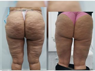 Liposuzione - Dott. Hicham Mouallem