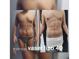 Liposuzione - Dott. Hicham Mouallem