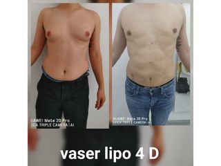 Liposuzione - Dott. Hicham Mouallem