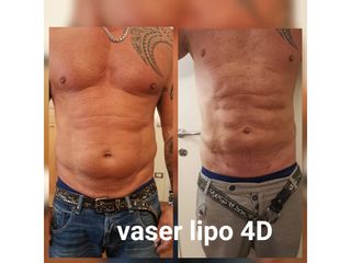 Liposuzione - Dott. Hicham Mouallem