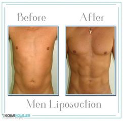 Liposuzione - Dott. Hicham Mouallem