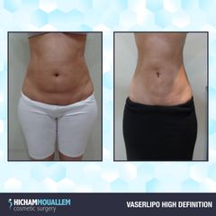 Liposuzione - Dott. Hicham Mouallem