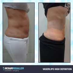 Liposuzione - Dott. Hicham Mouallem