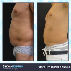 Liposuzione - Dott. Hicham Mouallem