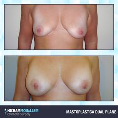 Mastoplastica additiva - Dott. Hicham Mouallem