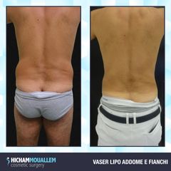 Liposuzione - Dott. Hicham Mouallem