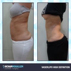 Liposuzione - Dott. Hicham Mouallem