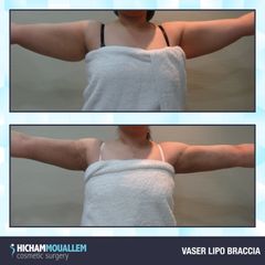 Liposuzione braccia - Dott. Hicham Mouallem