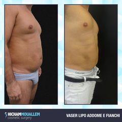 Liposuzione - Dott. Hicham Mouallem
