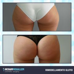 Gluteoplastica - Dott. Hicham Mouallem