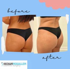 Gluteoplastica - Dott. Hicham Mouallem