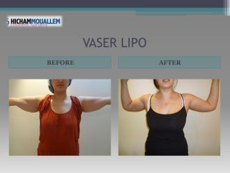 Lipo Vaser - 809655