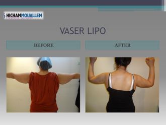 Lipo Vaser - 809659