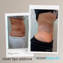 Liposuzione  - Dott. Hicham Mouallem
