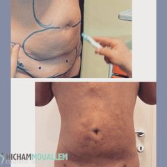 Liposuzione  - Dott. Hicham Mouallem