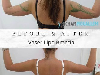 Lipo Vaser - 843891