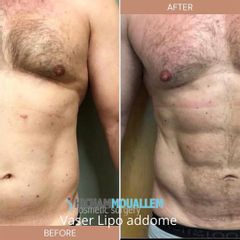 Liposuzione  - Dott. Hicham Mouallem