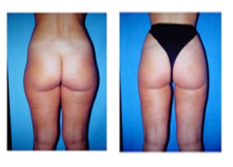 Liposuzione pre e post