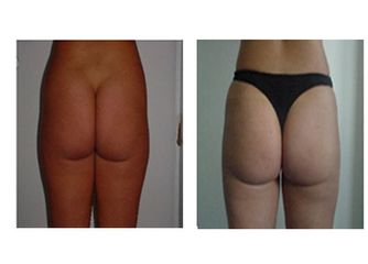 Liposuzione pre e post