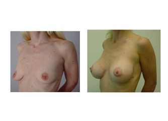 Mastoplastica Additiva pre e post