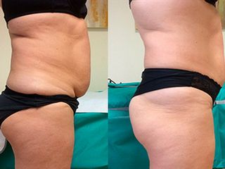 liposuzione prima dopo