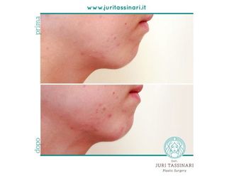 Filler - 308607