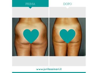 Liposuzione - 308610