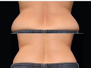 Criolipolisi con coolsculpting