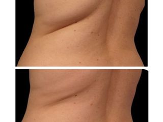 Criolipolisi con coolsculpting
