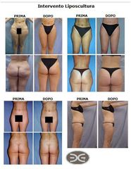 Liposcultura prima e dopo