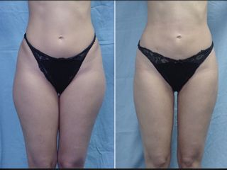Liposuzione prima e dopo