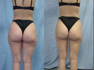 Liposuzione prima e dopo