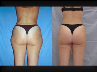 Liposuzione prima e dopo