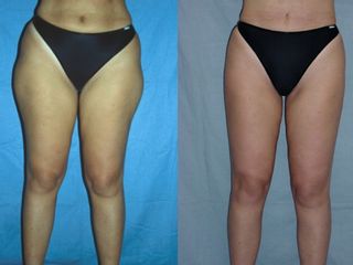Liposuzione prima e dopo