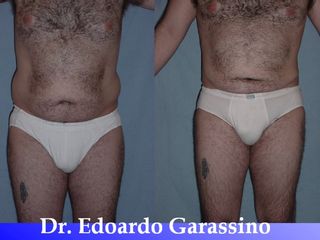 Liposuzione prima e dopo