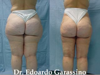 Obesitá prima e dopo