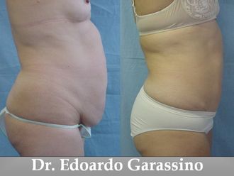 Riduzione stomaco prima e dopo - 759041