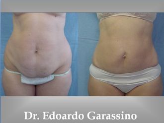 Riduzione stomaco prima e dopo - 759042