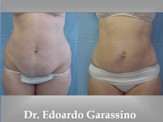 Obesitá prima e dopo