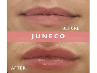 Filler labbra prima e dopo