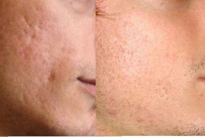 Needling prima e dopo - 746632