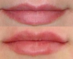 Aumento labbra prima e dopo