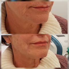 Filler - Dr.ssa Michela Centrone