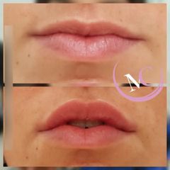 Filler labbra - Dr.ssa Michela Centrone