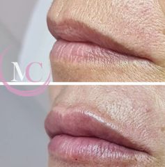 Filler labbra - Dr.ssa Michela Centrone