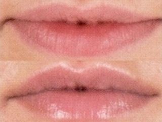 Rimodellamento labbra prima e dopo