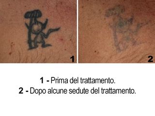 Rimozione tatuaggi - Dott. Stefano Berti