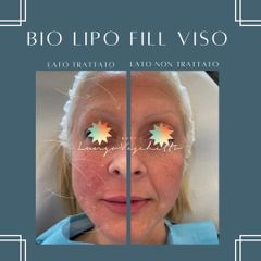 BIO LIPO FILL VISO - Dott. Luca Lungo Vaschetto