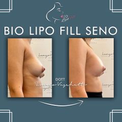 Bio lipo fill seno Dott. Luca Lungo Vaschetto