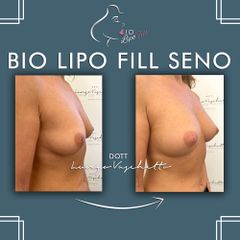 Bio lipo fill seno Dott. Luca Lungo Vaschetto